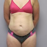 Tummy Tuck Before & After Patient #1784