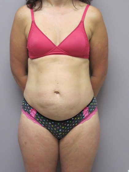 Tummy Tuck Before & After Patient #1784