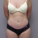 Tummy Tuck Before & After Patient #1784