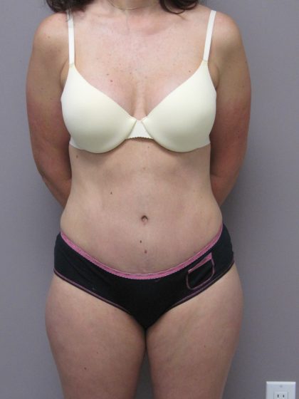 Tummy Tuck Before & After Patient #1784