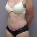 Tummy Tuck Before & After Patient #1784