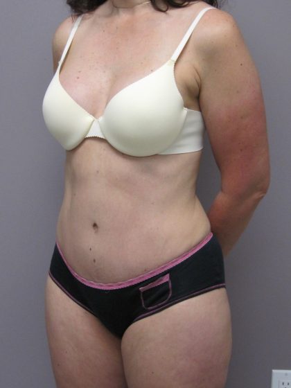 Tummy Tuck Before & After Patient #1784