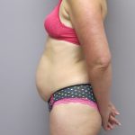 Tummy Tuck Before & After Patient #1784