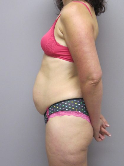 Tummy Tuck Before & After Patient #1784