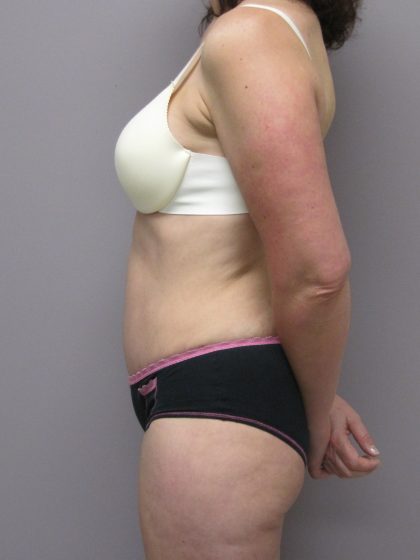 Tummy Tuck Before & After Patient #1784