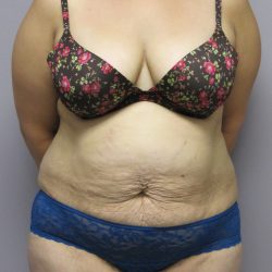 Tummy Tuck Before & After Patient #1783