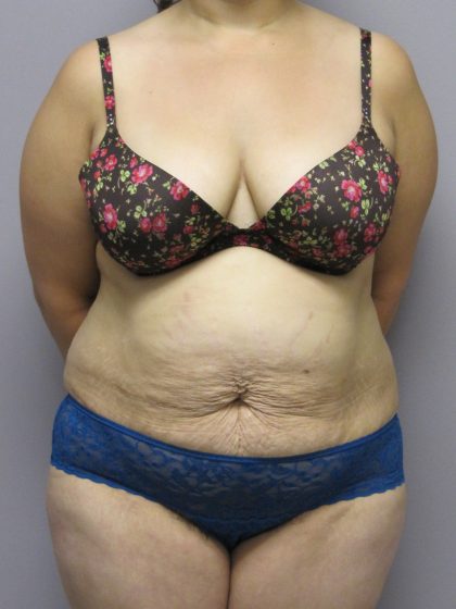 Tummy Tuck Before & After Patient #1783