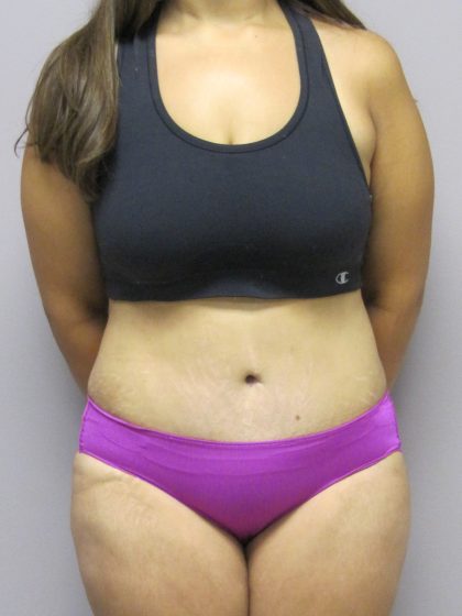 Tummy Tuck Before & After Patient #1783