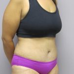 Tummy Tuck Before & After Patient #1783