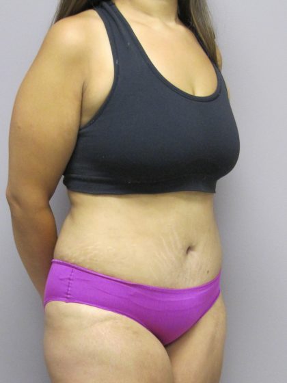 Tummy Tuck Before & After Patient #1783