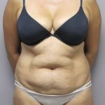 Tummy Tuck Before & After Patient #1782