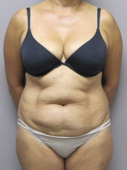 Tummy Tuck Before & After Patient #1782