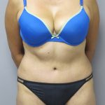 Tummy Tuck Before & After Patient #1782