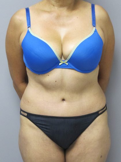 Tummy Tuck Before & After Patient #1782