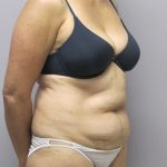 Tummy Tuck Before & After Patient #1782