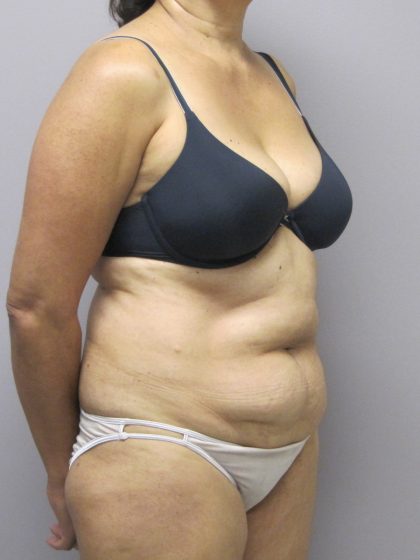 Tummy Tuck Before & After Patient #1782