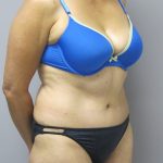 Tummy Tuck Before & After Patient #1782