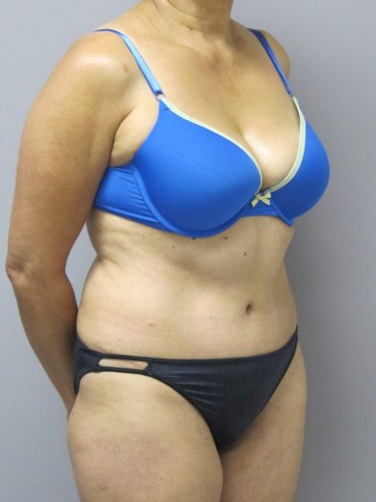 Tummy Tuck Before & After Patient #1782