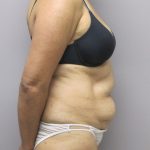 Tummy Tuck Before & After Patient #1782