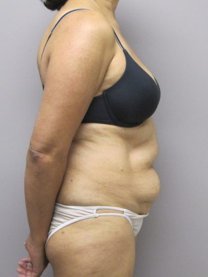 Tummy Tuck Before & After Patient #1782