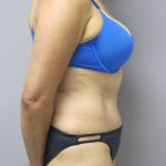 Tummy Tuck Before & After Patient #1782