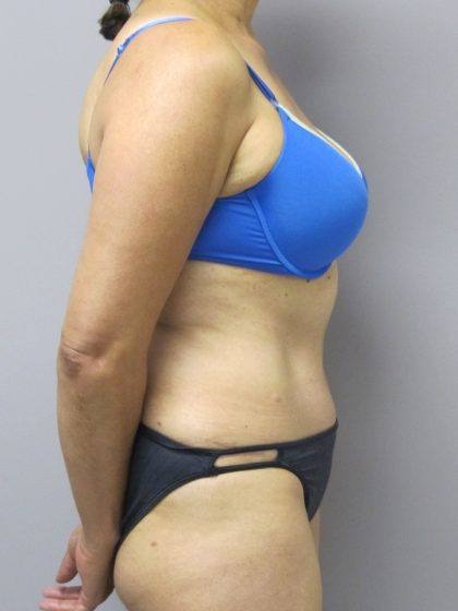 Tummy Tuck Before & After Patient #1782