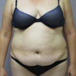 Tummy Tuck Before & After Patient #1781