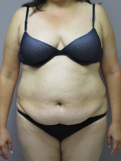 Tummy Tuck Before & After Patient #1781