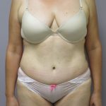 Tummy Tuck Before & After Patient #1781