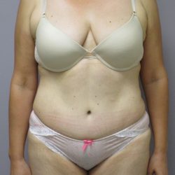 Tummy Tuck Before & After Patient #1781