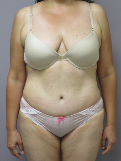 Tummy Tuck Before & After Patient #1781