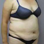 Tummy Tuck Before & After Patient #1781