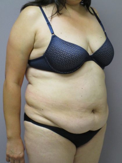 Tummy Tuck Before & After Patient #1781