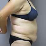 Tummy Tuck Before & After Patient #1781