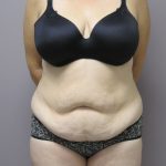 Tummy Tuck Before & After Patient #1780