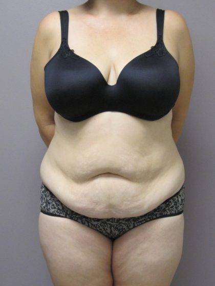 Tummy Tuck Before & After Patient #1780