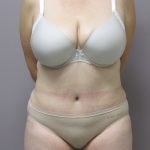 Tummy Tuck Before & After Patient #1780