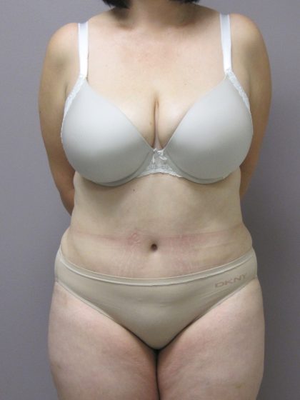 Tummy Tuck Before & After Patient #1780