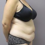 Tummy Tuck Before & After Patient #1780