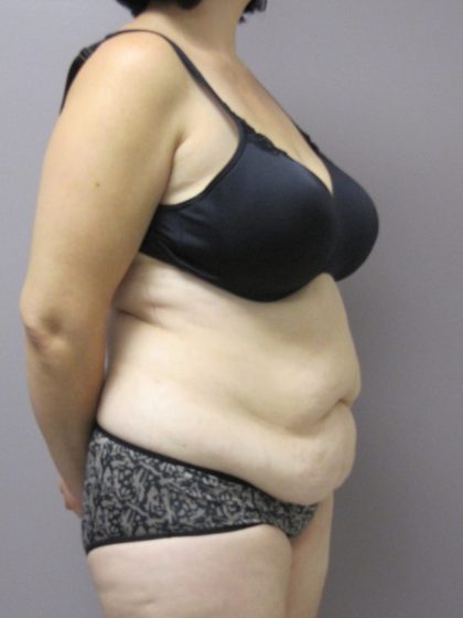 Tummy Tuck Before & After Patient #1780