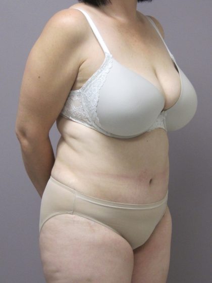 Tummy Tuck Before & After Patient #1780