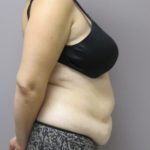 Tummy Tuck Before & After Patient #1780