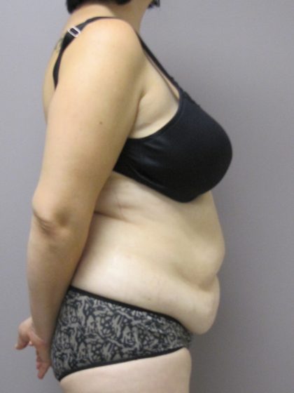 Tummy Tuck Before & After Patient #1780