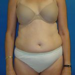 Tummy Tuck Before & After Patient #1779