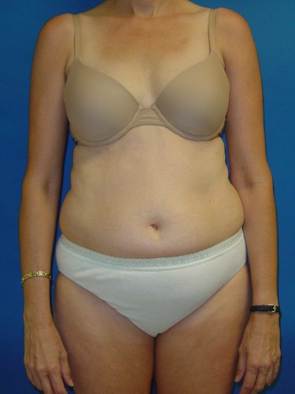 Tummy Tuck Before & After Patient #1779