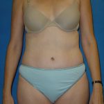 Tummy Tuck Before & After Patient #1779