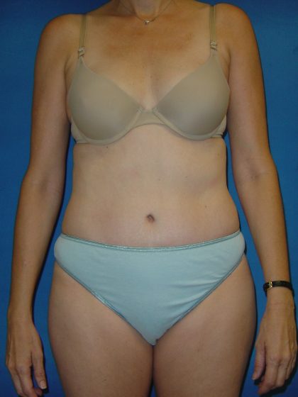 Tummy Tuck Before & After Patient #1779