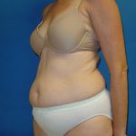 Tummy Tuck Before & After Patient #1779