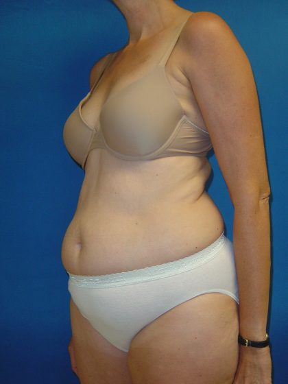 Tummy Tuck Before & After Patient #1779