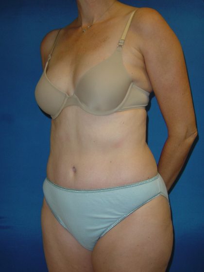 Tummy Tuck Before & After Patient #1779